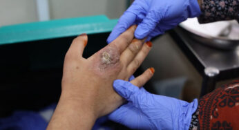 MSF Urges Funding Boost for Life-Saving Leishmaniasis Treatment in Pakistan