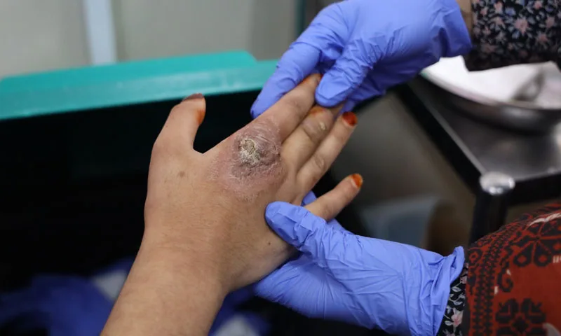 MSF Urges Funding Boost for Life-Saving Leishmaniasis Treatment in Pakistan