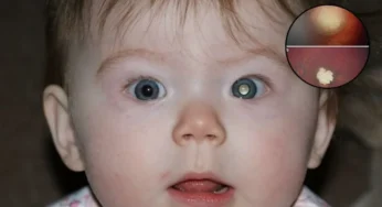 Pig Seminal Fluid Eye Drops Show Promise Against Cancer, Study Reveals