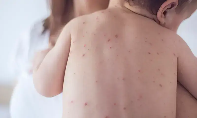 Three Children Die of Measles in Kandhkot; Family Blames Health Dept. Neglect